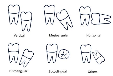 Pericoronitis Treatment Management Point Of Care