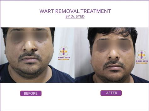 Wart Removal Treatment In Delhi Laser Wart Removal Dr Syed