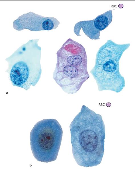 Transitional Cell Carcinoma Cytology