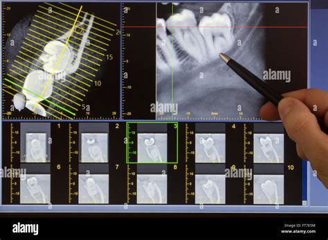 Doctor indicating a wisdom tooth on X-ray computed tomography Stock ...