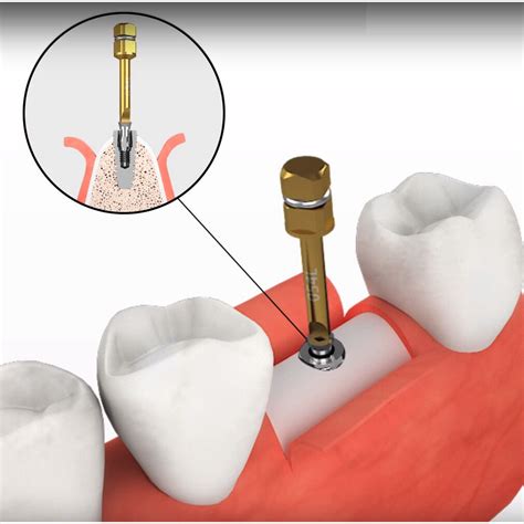 Rs Dental Implant Remove Broken Screw Extractor Surgical Tool