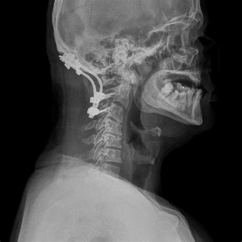 Profile X-ray of the cervical spine after occipitocervical fusion. | Download Scientific Diagram