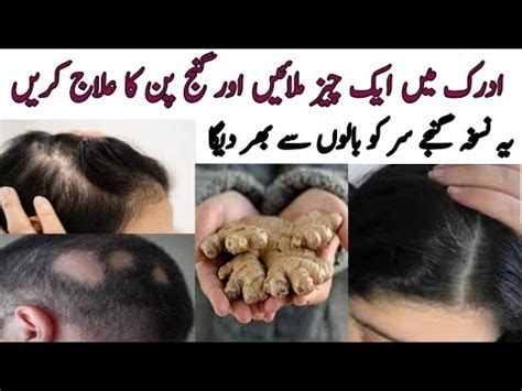 Baalchar Ka Elaj Alopecia Treatment Ganjpan Ka Ilaj How To Make