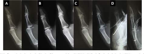 Figure 1 From Recurrent Volar Dislocation Of The Metacarpophalangeal