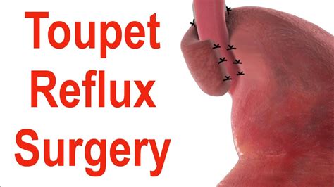 Toupet Fundoplication Or 270° Stomach Wrap Surgery To Treat Reflux