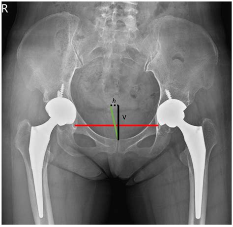 Degree Of Pelvic Rotation In The Coronal Plane On Postoperative