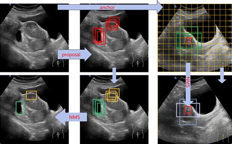 Real Time Automatic Assisted Detection Of Uterine Fibroid In Ultrasound