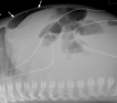 Necrotizing Enterocolitis Review Of State Of The Art Imaging Findings