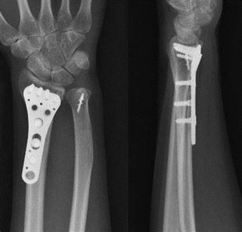 Bidirectional Dislocation Of The Distal Radioulnar Joint After Distal