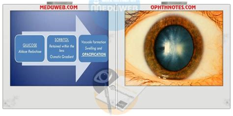 Diabetic Cataracts - Meduweb