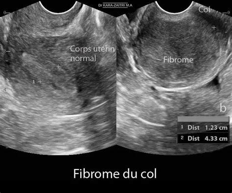 Fibrome Du Col 2 Dr Kara Zaitri M A