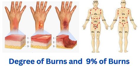 Degree Of Burns And 9 Of Burns Youtube