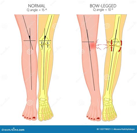 Shapes Of The Legsnormal And Curved Legsknock Kneesbowed Leg Stock