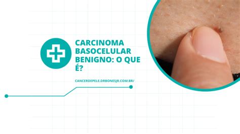 Carcinoma Basocelular Especialista Em Câncer De Pele