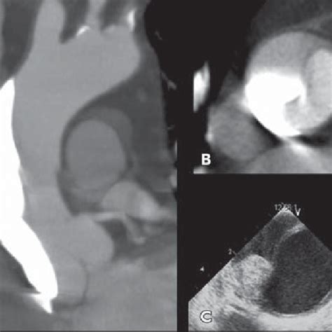 Year Old Man With Grade Aortocoronary Dissection Initially Evaluated