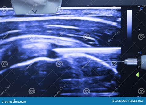 Epi Dry Needling Ultrasound Scan Stock Image Image Of Medical Medicine 205186405