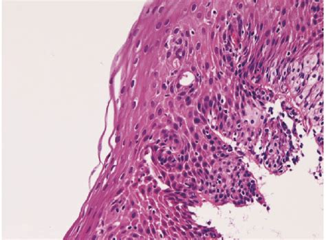 cmv esophagitis | Semantic Scholar