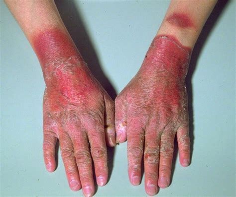 Carcinoid Syndrome Rash