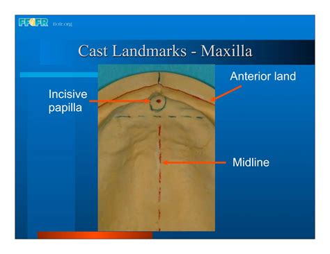 Complete Dentures 16occlusal Schemes Lingualized Occlusion Ppt