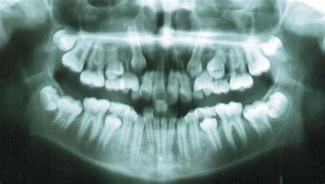 Chapter 3: Second molar extractions | Pocket Dentistry