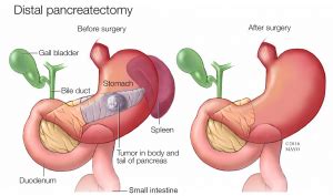 Distal Pancreatectomy – GBMC Jordan