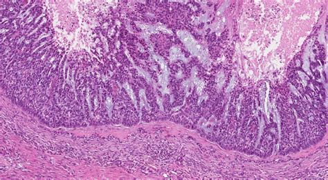 Basal cell carcinoma of the skin | Ottawa Atlas of Pathology