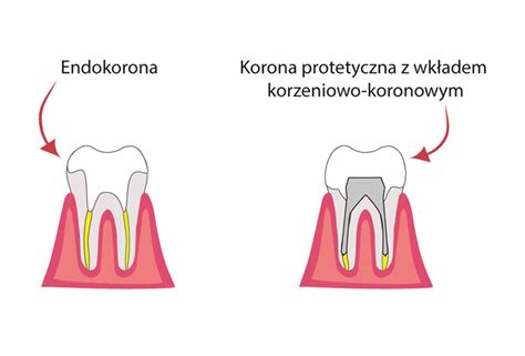 Endokorony korony i mosty odbudowa zęba po leczeniu kanałowym