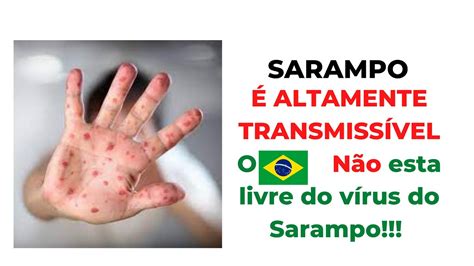 Aula Completa Sobre SARAMPO Quais Os Sintomas Como Se Transmite