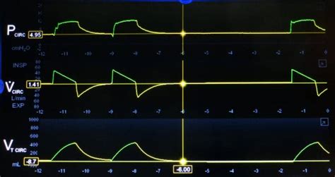 Understanding Ventilator Basics And Ventilator Waveforms Rt