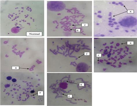 Photomicrographs Of Normal And Chromosomal Aberrations In Bone Marrow