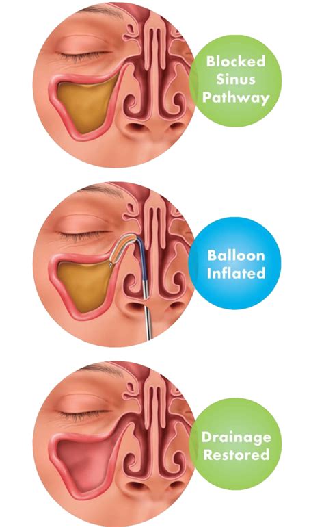 The Basics On Balloon Sinuplasty Phoenix Phx