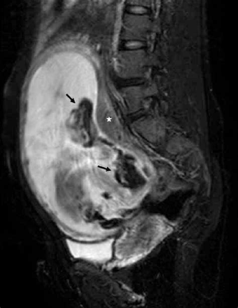 On This T2 Weighted Fat Suppressed Sagittal Image An Intact Placenta Download Scientific