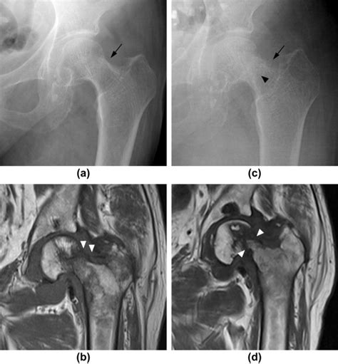 Various Musculoskeletal Manifestations Of Chronic Renal Insufficiency Clinical Radiology