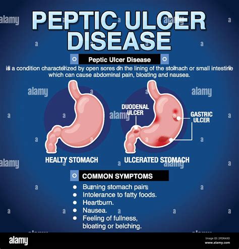 Peptic Ulcer Disease Causes Symptoms Diagnosis Treatment Pathology ...