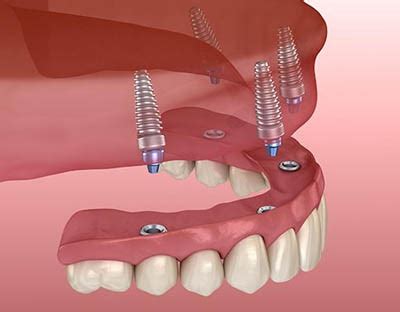 All On Dental Implants In Coral Gables Fl Flossy Smiles