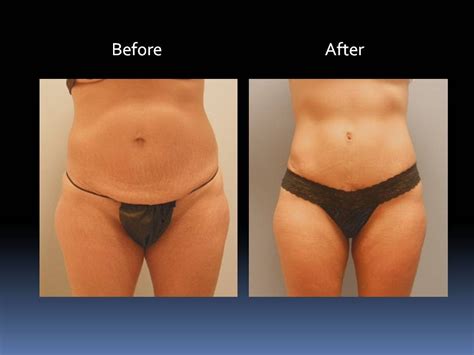 New Tummy Tuck Before And After By Dr Emily Pollard Youtube