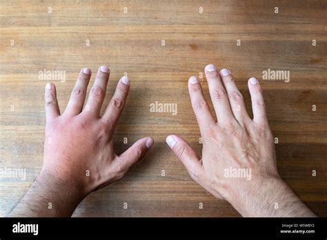 Comparison Of Two Male Hands Stung By Bee Or Wasp Hand Swelling