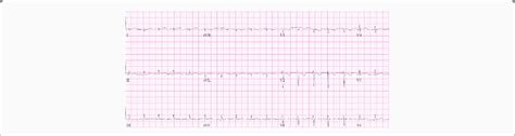 EKG suggesting low voltage QRS | Download Scientific Diagram