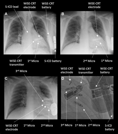 The Importance Of Leadless Pacemaker Positioning In Relation To