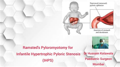 Ramsteds Pylormyotomy For Infantile Hypertrophic Pyloric Stenosisihps