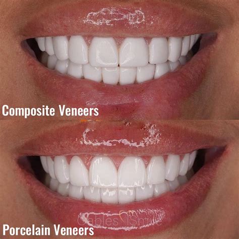 Composite vs Porcelain Veneers: Which is Better? | iSmile