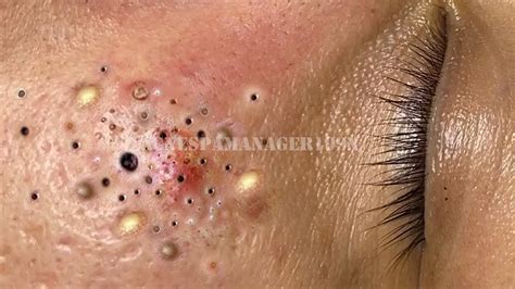 What Is The Sac In A Blackhead At Hector Gill Blog