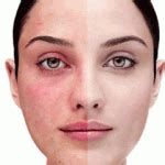 Rosacea / Red Skin - Granville Bridge Medical CentreGranville Bridge ...