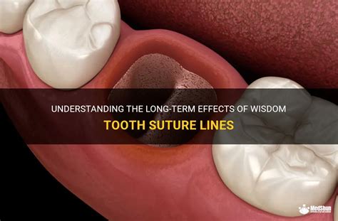 Understanding The Long Term Effects Of Wisdom Tooth Suture Lines Medshun