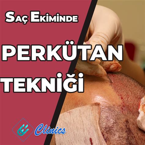 Perkütan Tekniği ile Saç Ekimi EE Clinics Turkiye