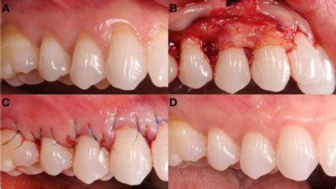 A Comparative Study Of Root Coverage Using OrACELL Subepithelial