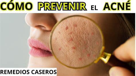 Cómo prevenir el acné Tips y remedios caseros efectivos YouTube