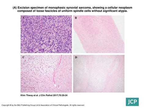 A Excision Specimen Of Monophasic Synovial Sarcoma Showing A