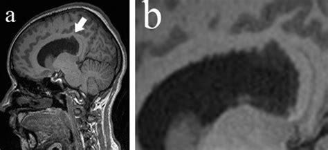 28 Year Old Female With Septum Pellucidum Subependymoma A Plain Mri