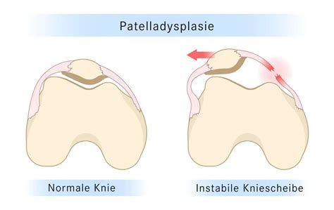 Patelladysplasie Behandlung Und Therapie Medneo